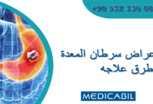 أسباب سرطان المعدة