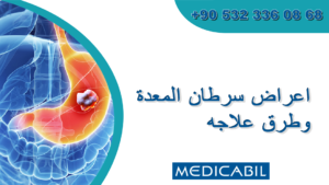 أسباب سرطان المعدة